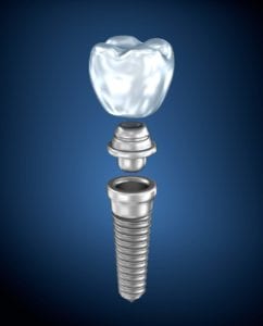 Cost of Dental Implants in Skokie IL