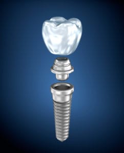 Dental Implants near Glencoe Illinois
