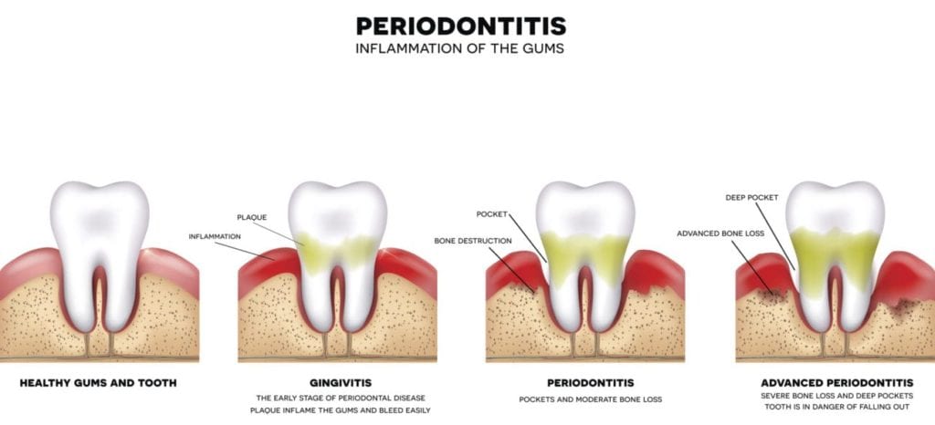 signs of gum disease and treatment in Skokie, Illinois