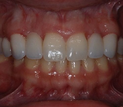 After cosmetic dentistry at The Stein Center for Advanced Dentistry
