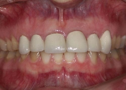 Before cosmetic dentistry at The Stein Center for Advanced Dentistry