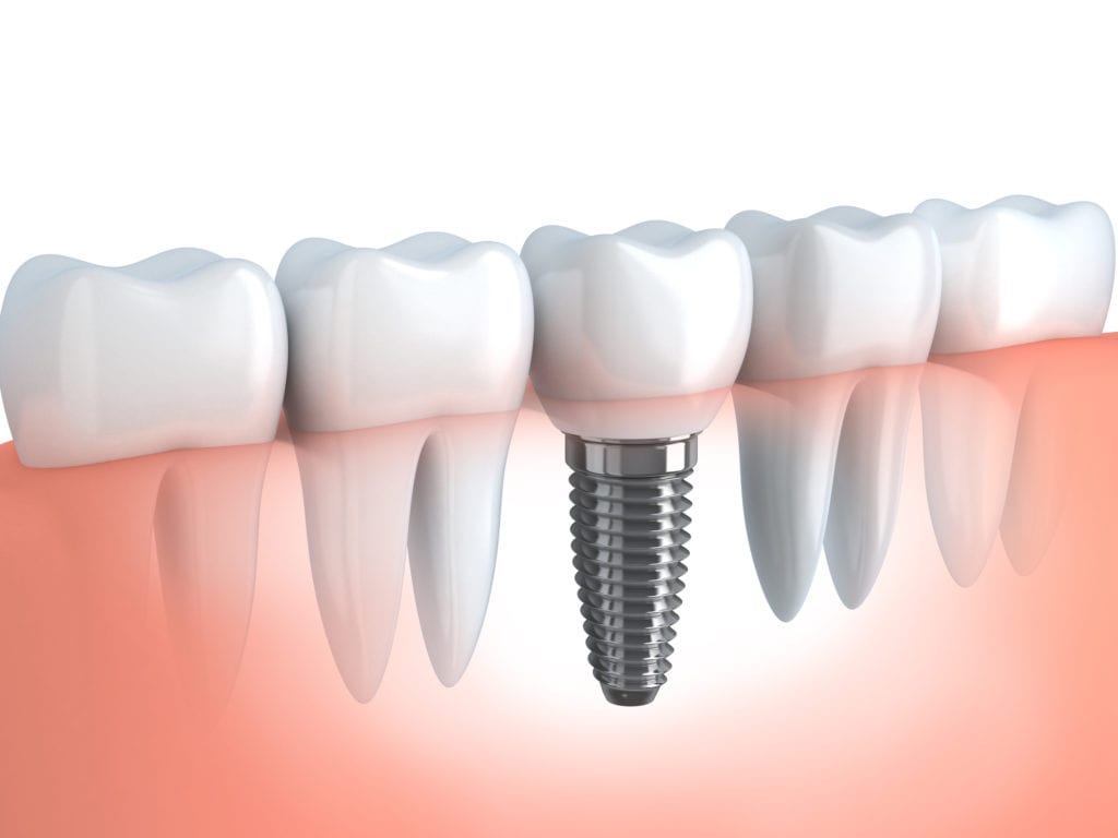 Dental implant process in Skokie Illinois