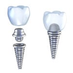 Dental implant crown highland park il