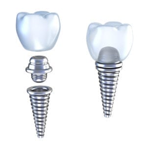 Dental implants in Skokie, IL