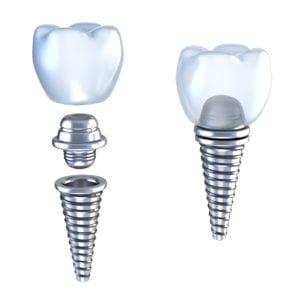 Affordable dental Implants in Wilmette Illinois