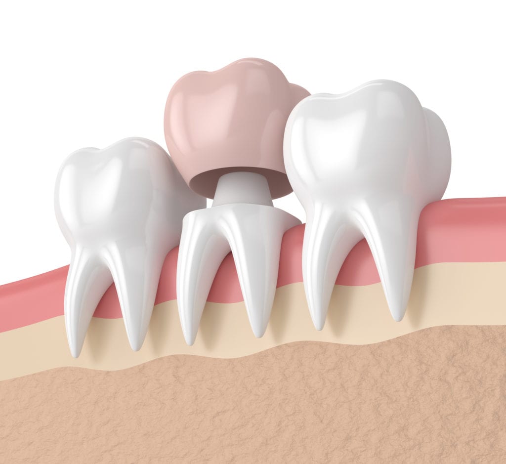 dental crown in Evanston Illinois