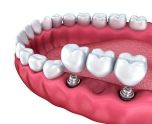 dental implant bridge Evanston IL