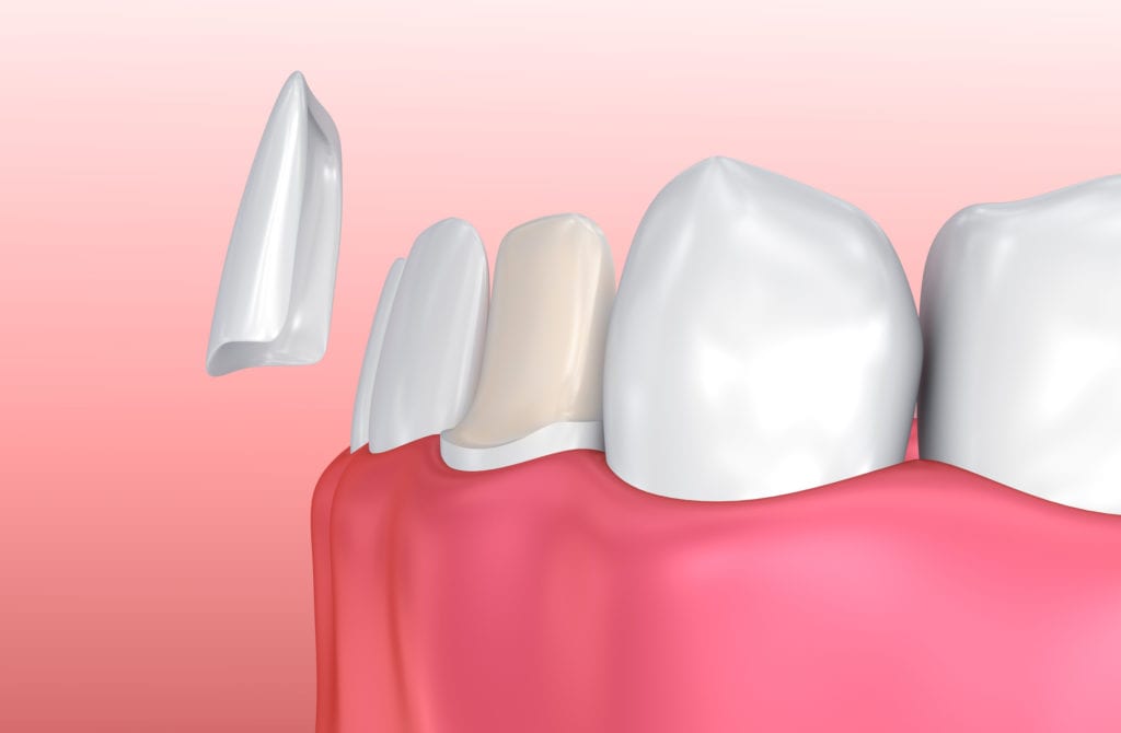 Porcelain veneer Evanston IL