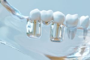 skokie, il dental implants