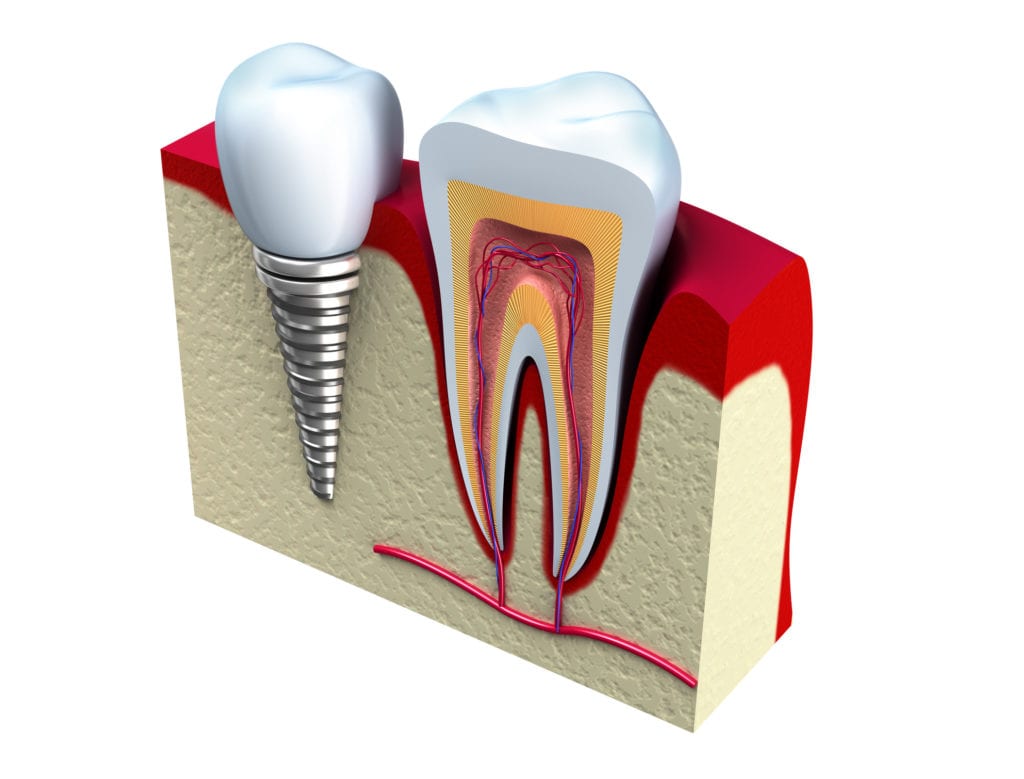 A single dental implant can replace a lost tooth