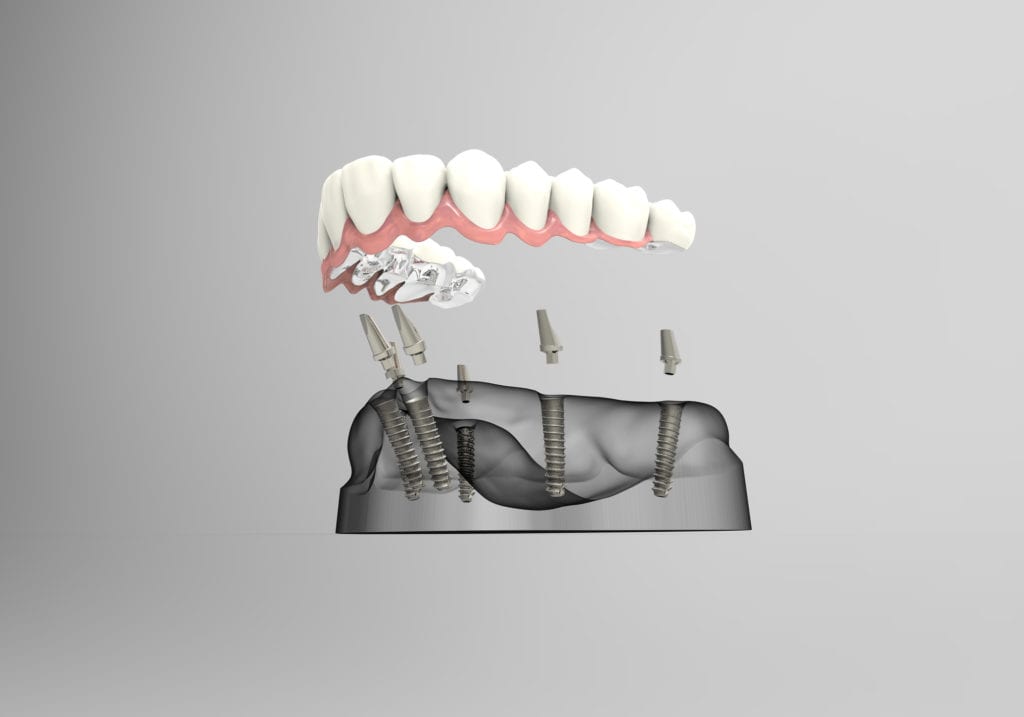 Multiple dental implants in Skokie, IL