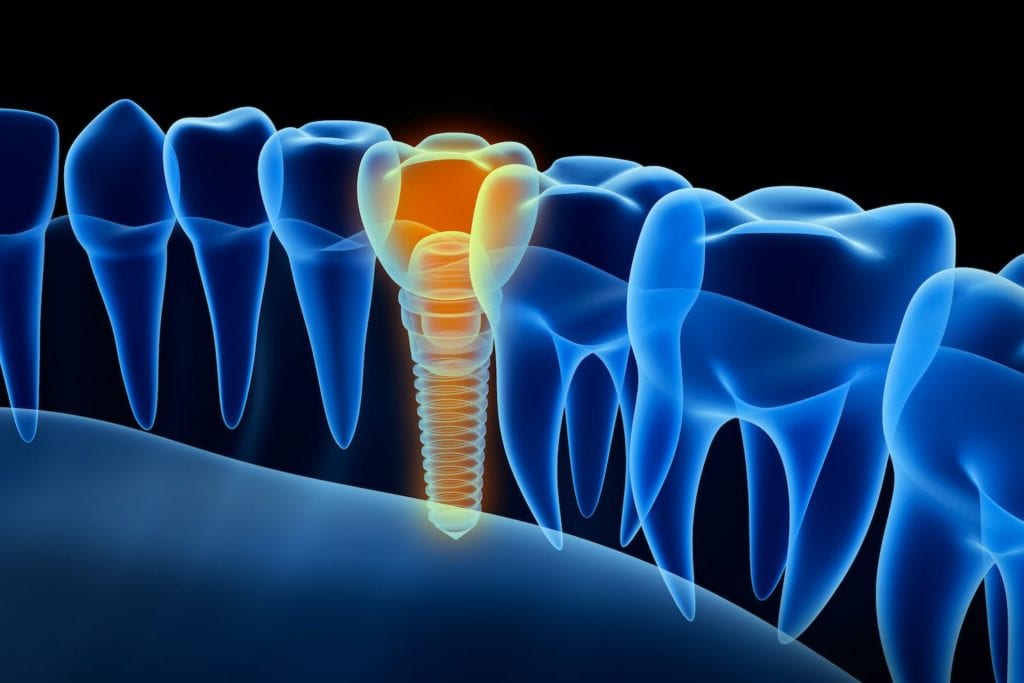 Dental Implants in Glenview IL