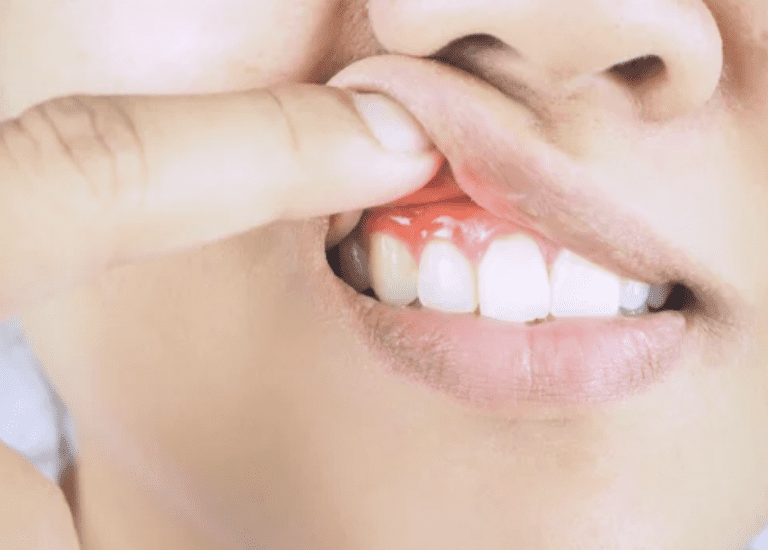 image of woman pulling her lips up to reveal red swollen gums gum disease dentist in Skokie Illinois 